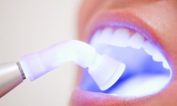 dental fillings services