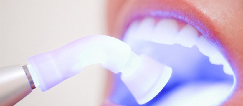 dental fillings services