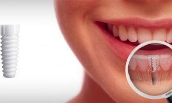 dental implants advantages and disadvantages