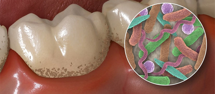 tooth plaque bacteria