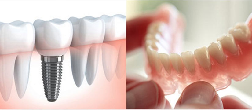 Dental Implants Vs Dentures