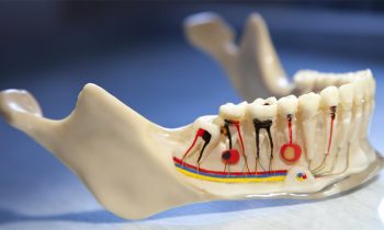 root canal treatment services